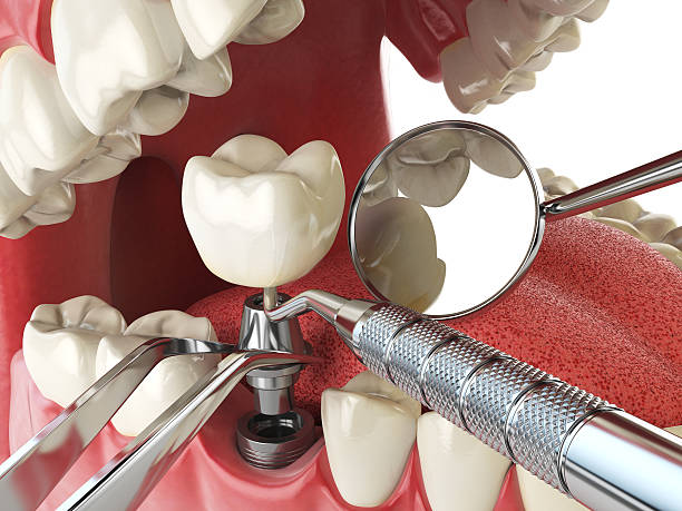 Best Urgent Care for Lost Fillings or Crowns in Waukegan, IL